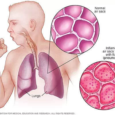 Image: Clinton's pneumonia, Trump's self-aggrandizing "charity" and Monday headlines